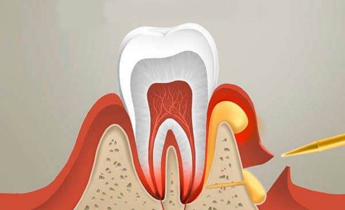Как избавиться от нагноения десны?