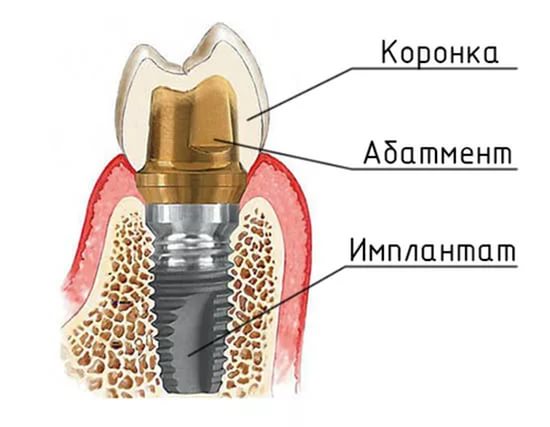 Имплант под ключ