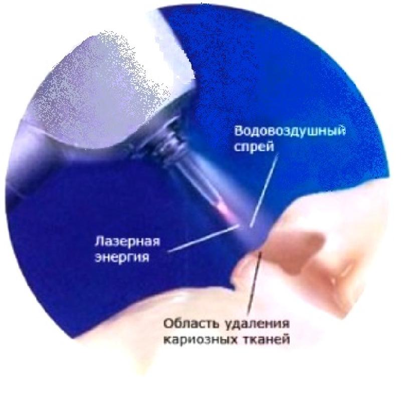 лазерное лечение зубов